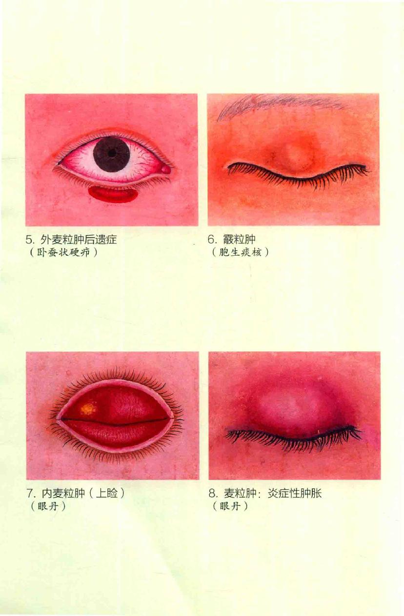 眼病治疗绝招王霖有_978-7-5132-4379-7.pdf_第6页