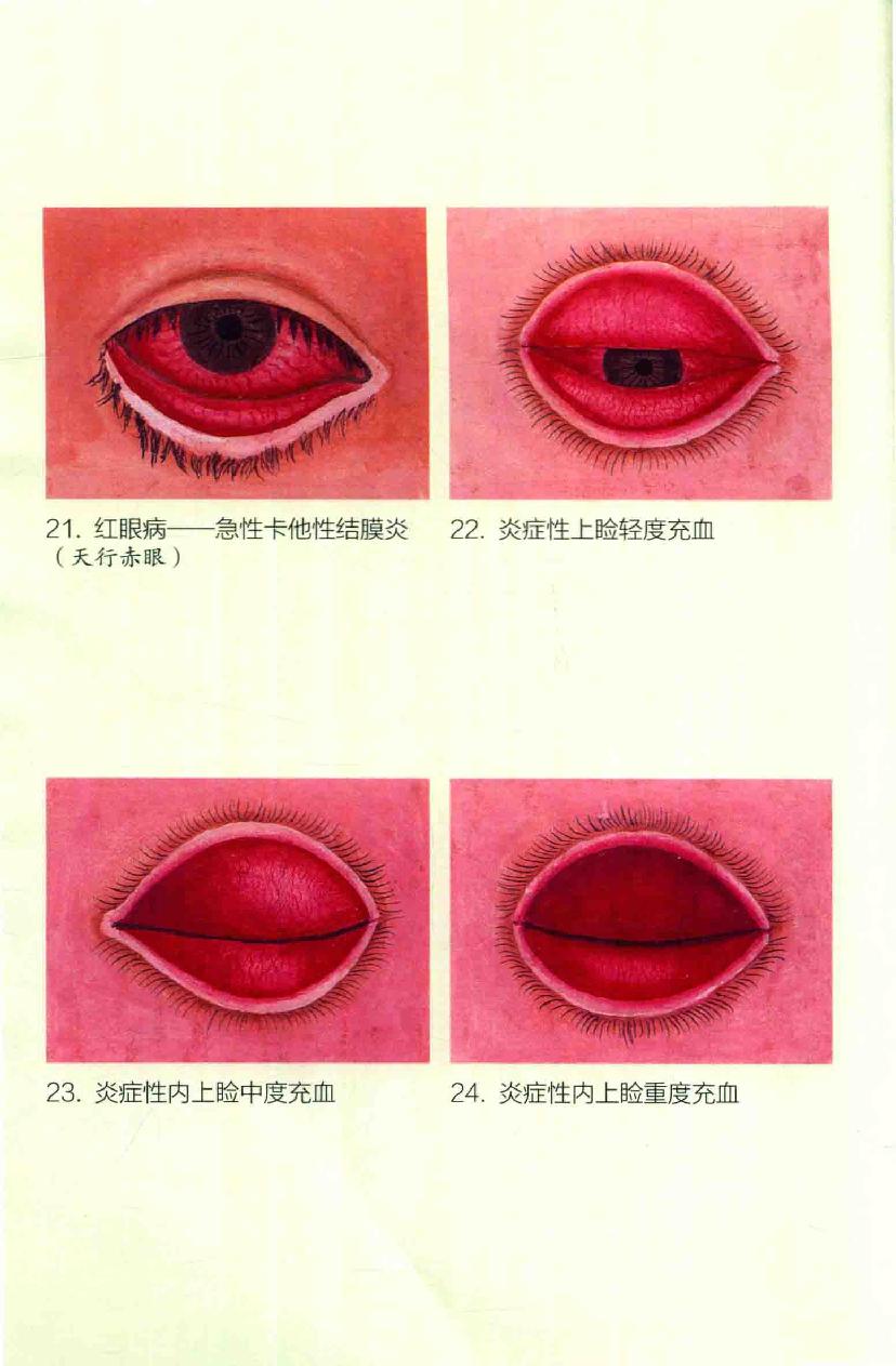 眼病治疗绝招王霖有_978-7-5132-4379-7.pdf_第10页